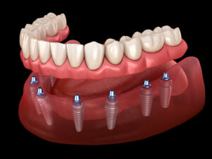 implante dentário